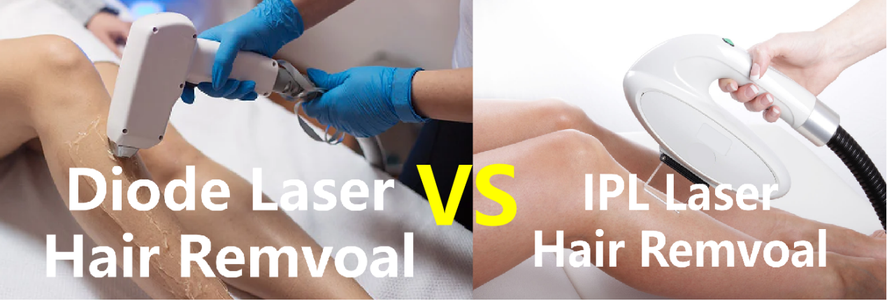 IPL VS DIODELASER HAARVERWIJDERING