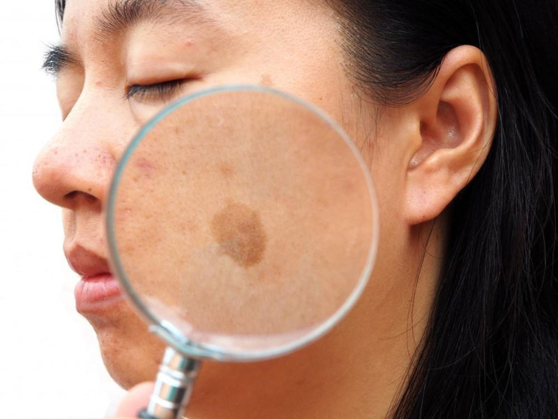 Picoseconde laser: een goede helper om melasma te verwijderen